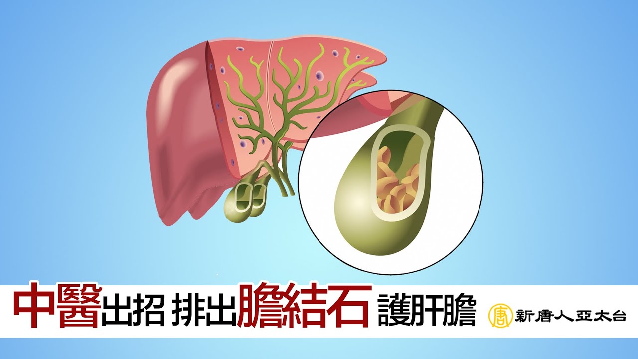中醫出招！排出『膽結石』疏肝利膽秘笈在這裏  談古論今話中醫488