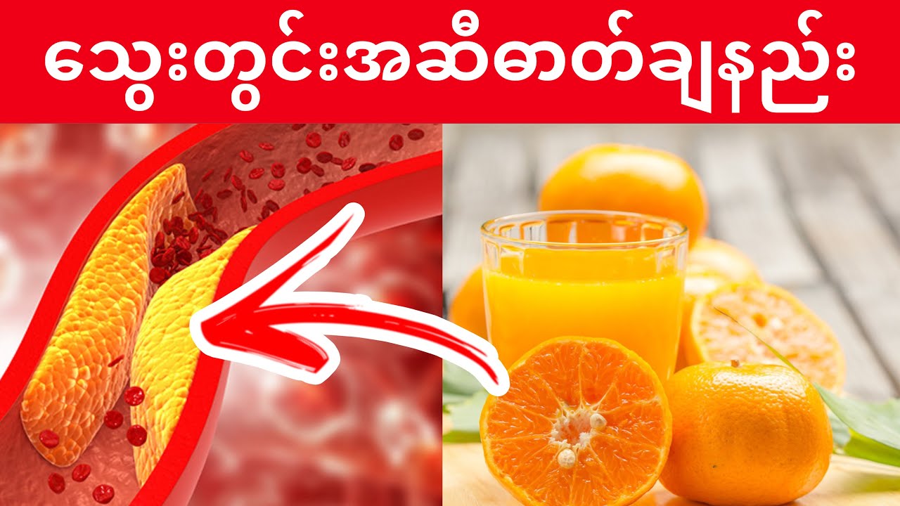 သွေးတွင်းအဆီဓာတ်ချ သဘာဝနည်းလမ်း (၇) ခု (သွေးကြောကျဉ်း၊ပိတ်ခြင်း ကာကွယ်နည်း)