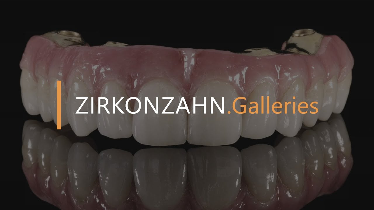 Prettau® 4 Anterior® zirconia on Sintermetall | Zirkonzahn.Galleries