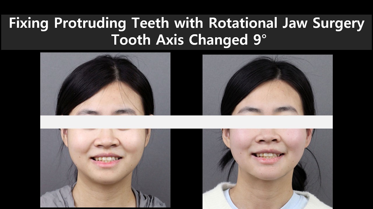 How I Fixed Protruding Teeth AND an Underbite with ONE Surgery   9° Tooth Axis Change