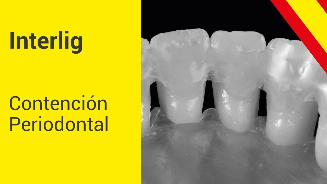 INTERLIG - Contención Periodontal