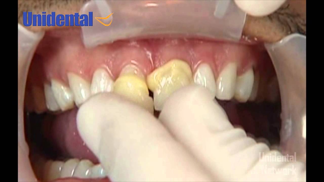 Lumineers, las carillas veneers ultra delgadas!!