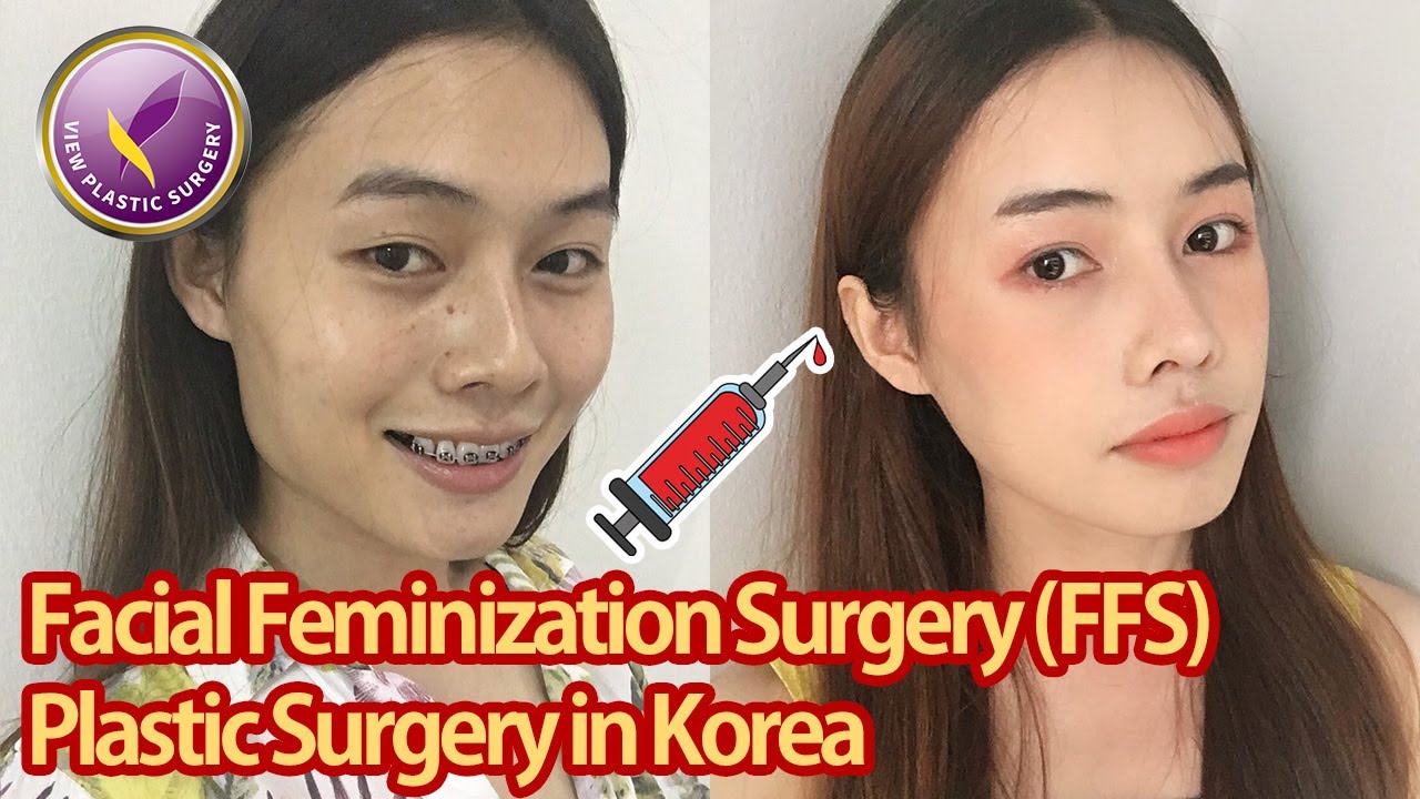 【View Plastic Surgery】 Transgender FFS in Korea