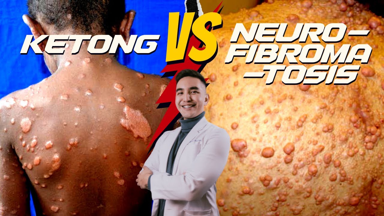 5 Signs ng Ketong (Leprosy) vs Neurofibromatosis #kilimanguru