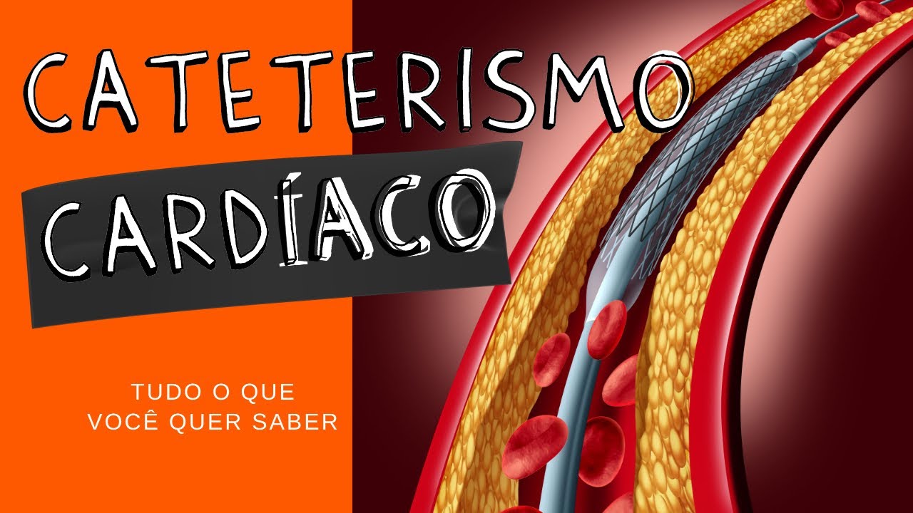 CATETERISMO CARDÍACO: Tudo o que você quer saber!