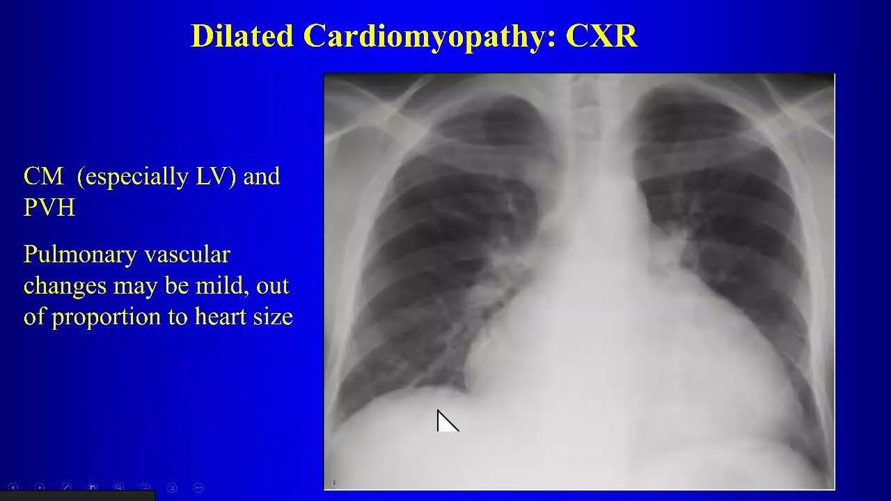 7 MRI of Myocarditis Cardiomyopathies