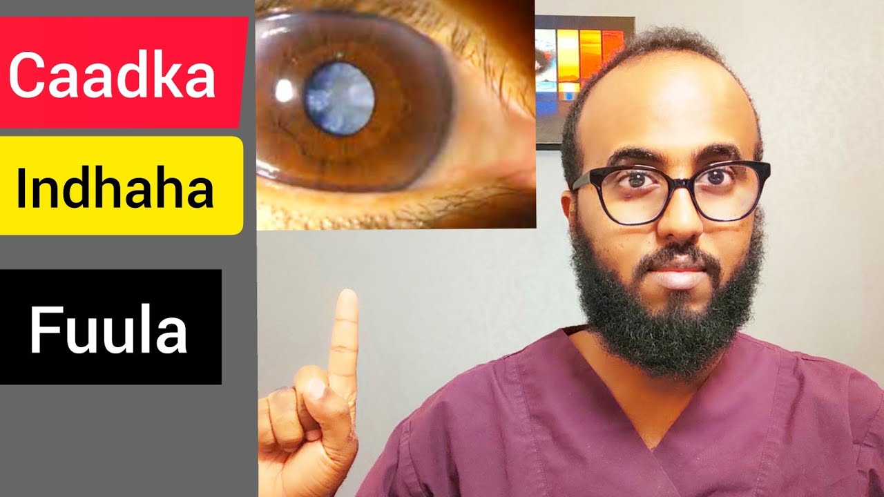 Caadka indhaha Fuula- Cataract