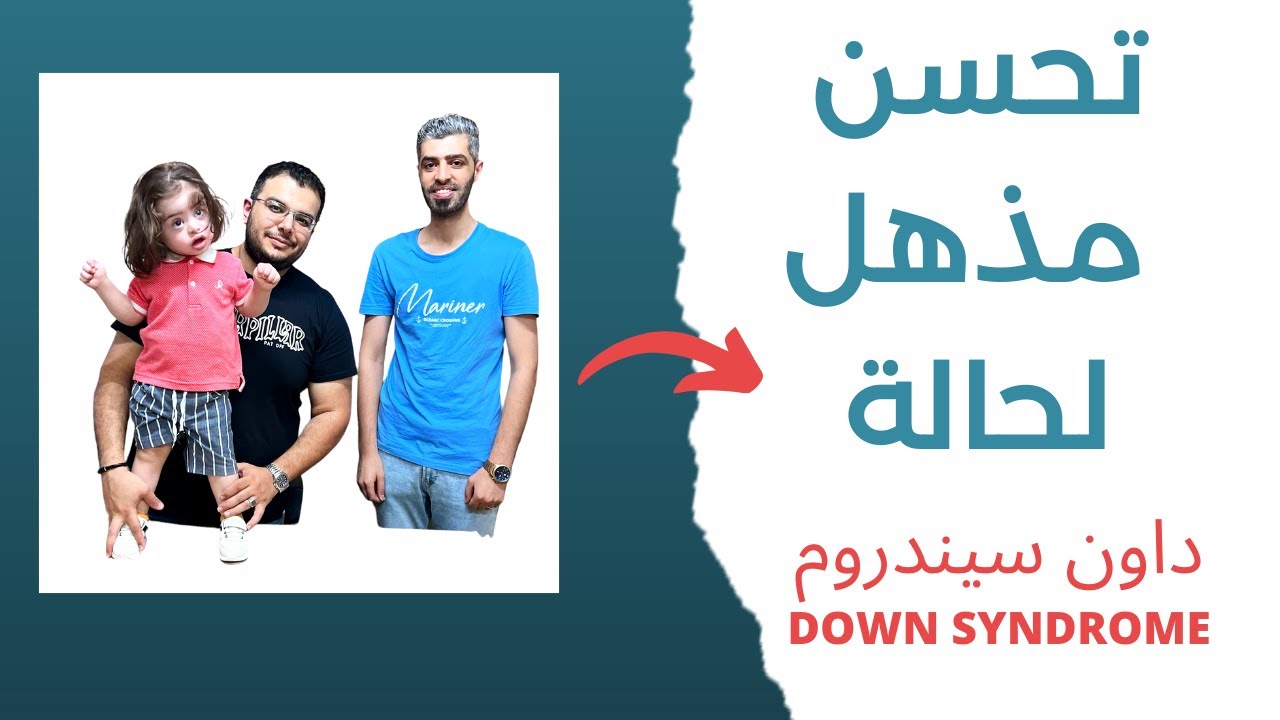تحسن مبهر لحالة داون سيندروم | Down Syndrome