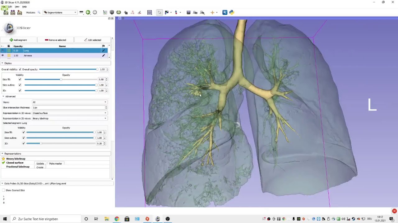 Airway segmentation in 3D Slicer with 