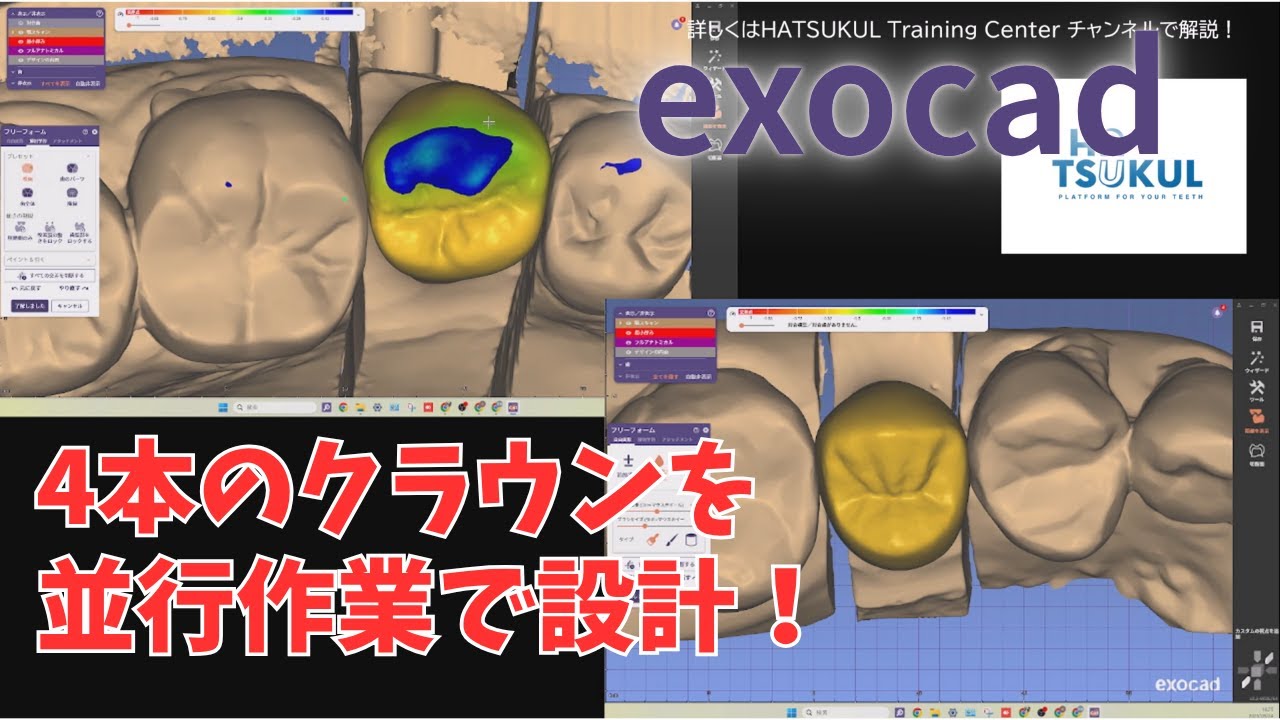 #196　exocad設計　4本のクラウンを同時に並行設計！（解説なし版）