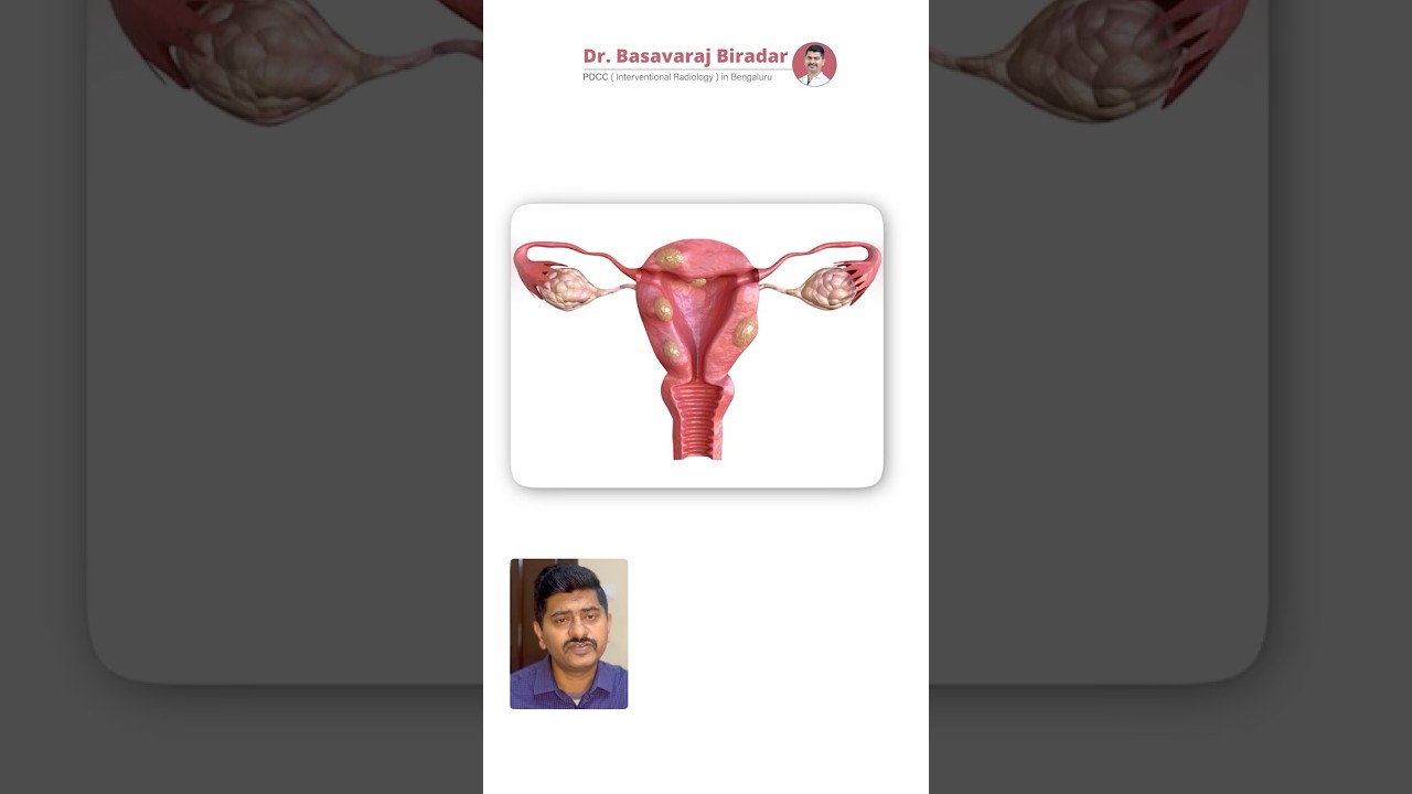 Uterine Fibroid Embolization| ಸರ್ಜರಿ ಇಲ್ಲದೆ ಫೈಬ್ರಾಯ್ಡ್ ಚಿಕಿತ್ಸೆ  #bangalore #fibroids #women shealth