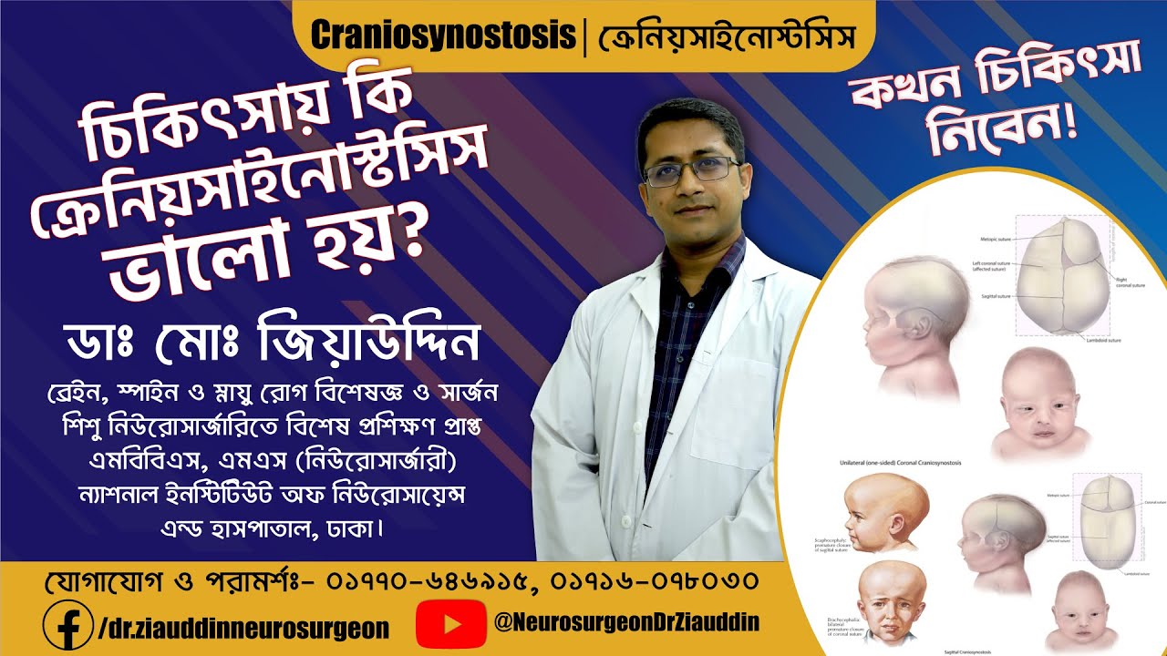 Craniosynostosis || ক্র্যানিওসিনোস্টোসিস - Paediatric neurosurgeon in Bangladesh #neurosurgeon
