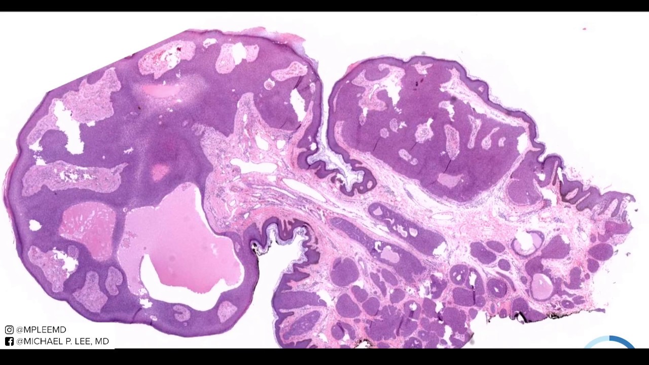 Eccrine Poroma (with a twist, hybrid acrospiroma) explained by a dermatopathologist unknown 11.