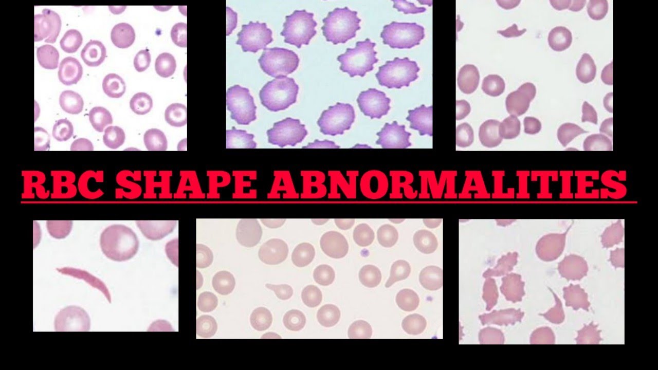 RBC Shape Abnormalities In Peripheral 🩸Blood Smear | Made Easy | Images