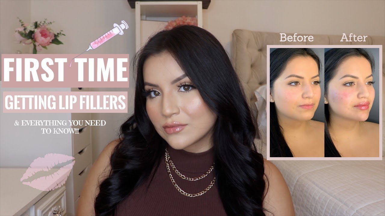 I GOT FILLERS! Lips, Cheeks, & Chin | MY FIRST EXPERIENCE + how it went!!