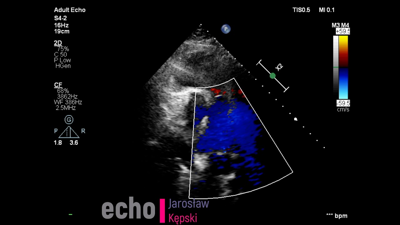 Patent Ductus Arteriosus (PDA) in an Adult &ndash; Echocardiography Case of a Congenital Heart Defect