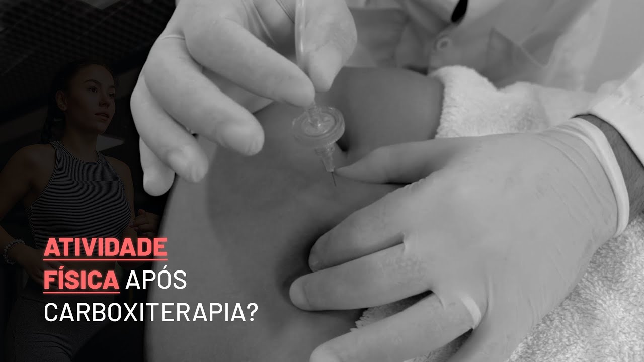 Atividade física após carboxiterapia?