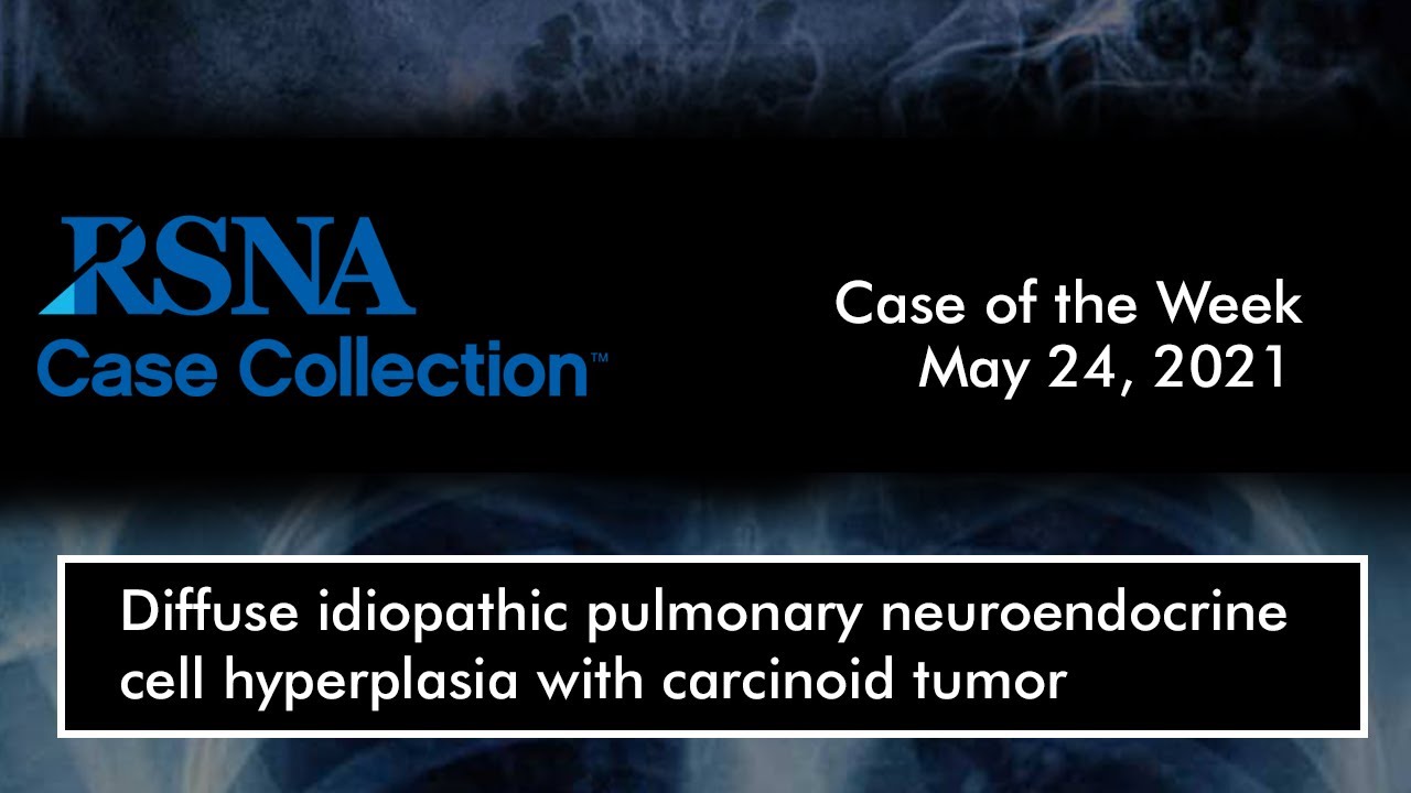 Case of the Week: Diffuse idiopathic pulmonary neuroendocrine cell hyperplasia with carcinoid tumor
