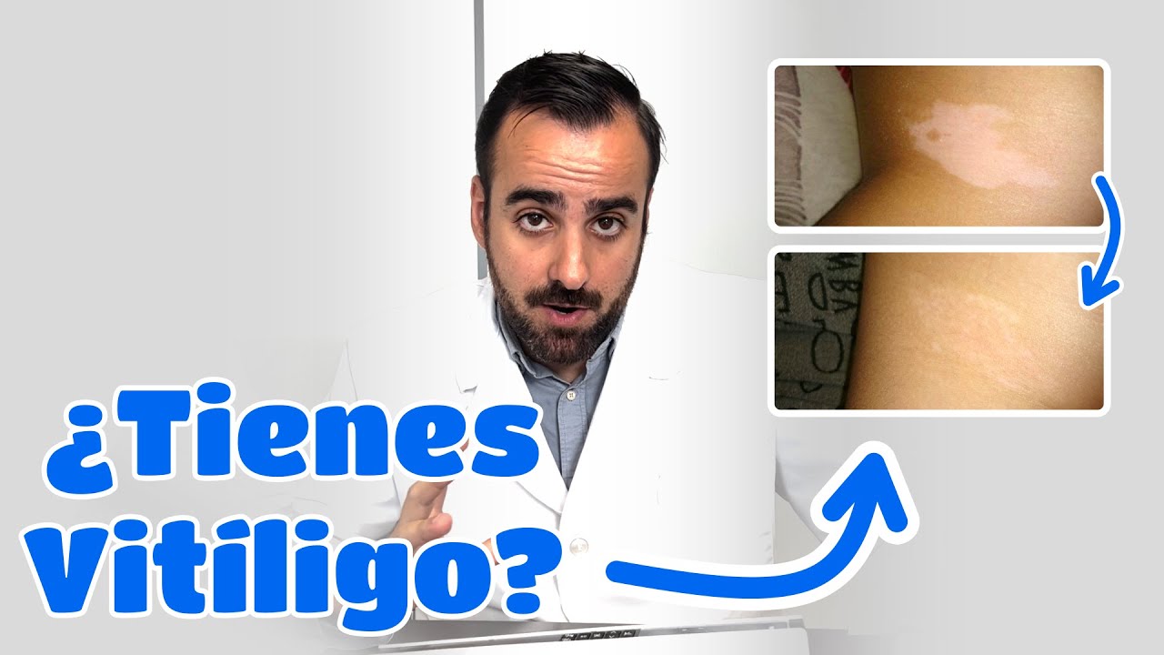 Vitiligo porque da, Tenemos una solución para el Vitiligo