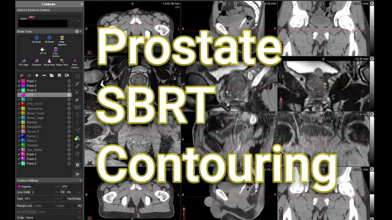 Prostate SBRT Contouring