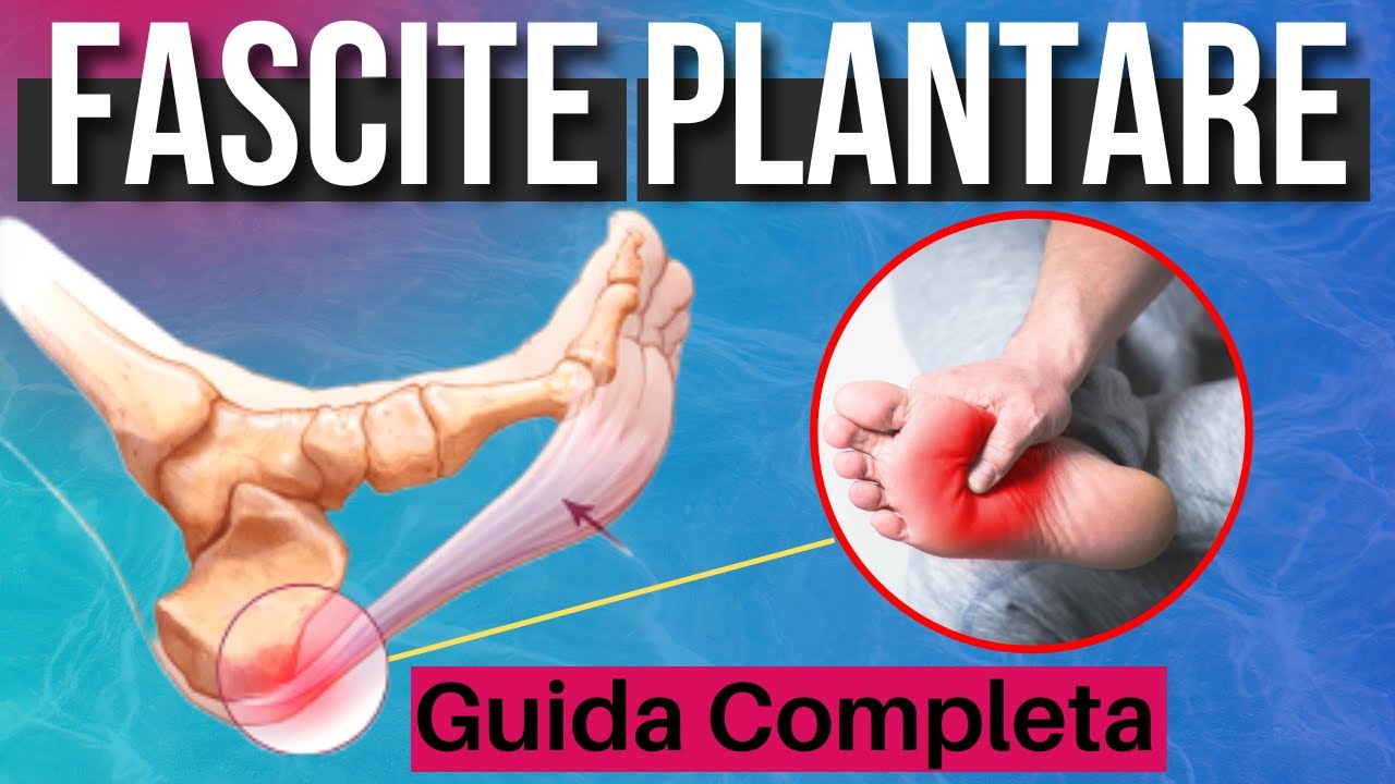FASCITE PLANTARE: tutto quello che DEVI SAPERE per GUARIRE definitivamente!