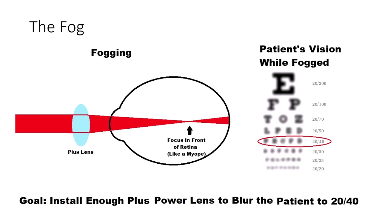 The Fog or how accommodation is controlled Source
