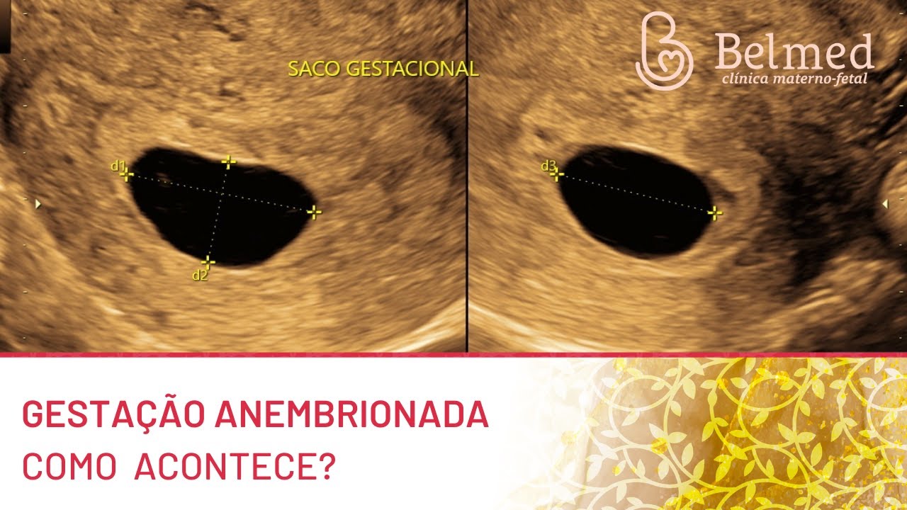 GESTAÇÃO ANEMBRIONADA - JÁ OUVIU FALAR?