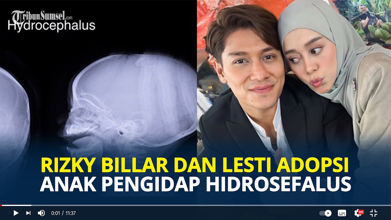 RIZKY Billar dan Lesti Kejora Diam diam Adopsi Anak Pengidap Hidrosefalus, Sudah 6 Bulan Kami Biayai