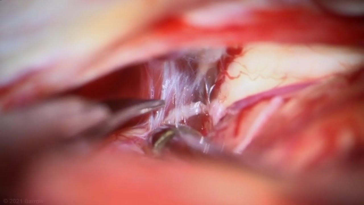 Posterior Interhemispheric Approach for Occlusion of a Galenic (Type 1) Tentorial DAVF