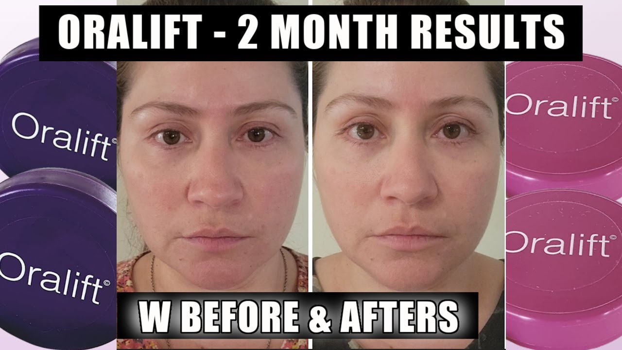ORALIFT | 2 MONTHS RESULTS W BEFORE & AFTERS