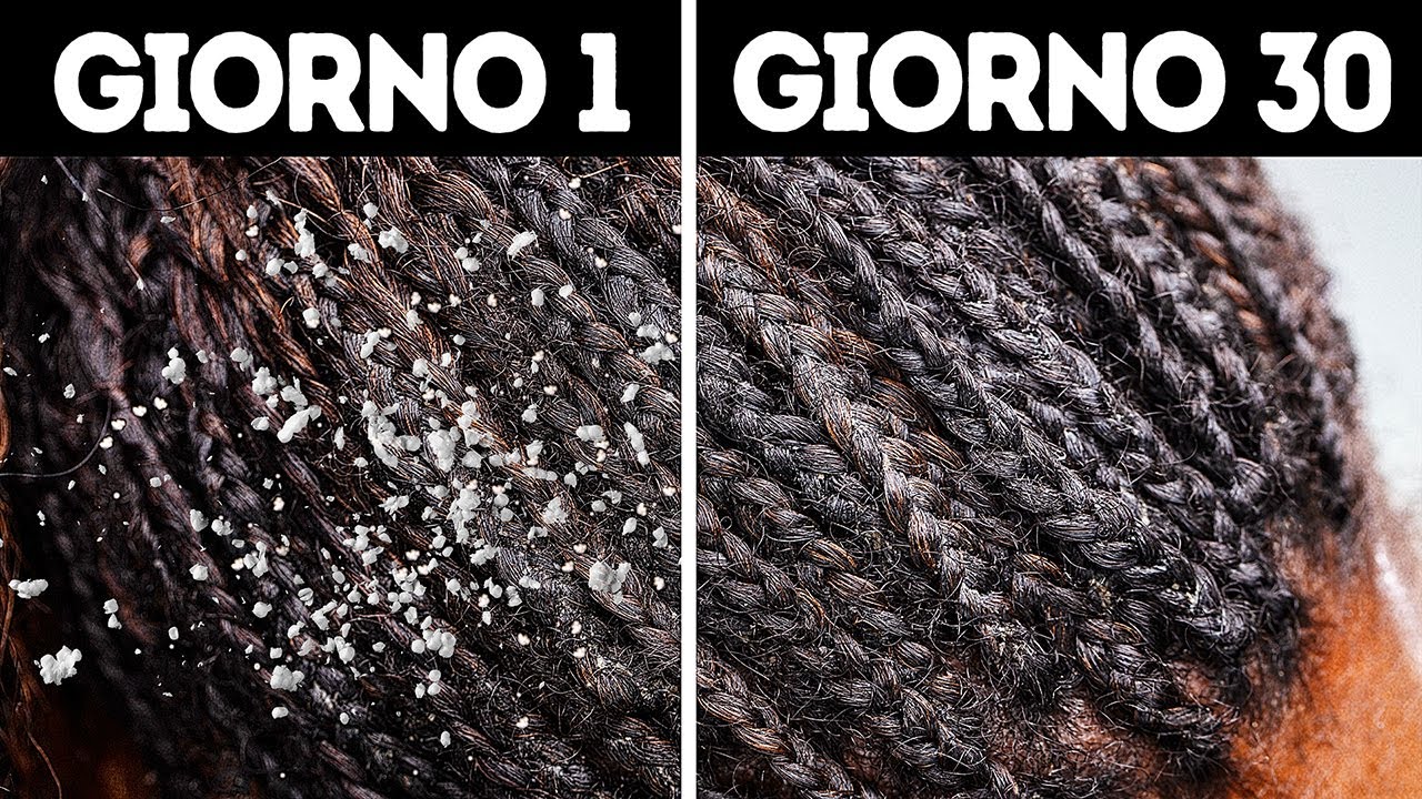 10+ Rimedi Naturali Per Liberarsi Per Sempre Dalla Forfora