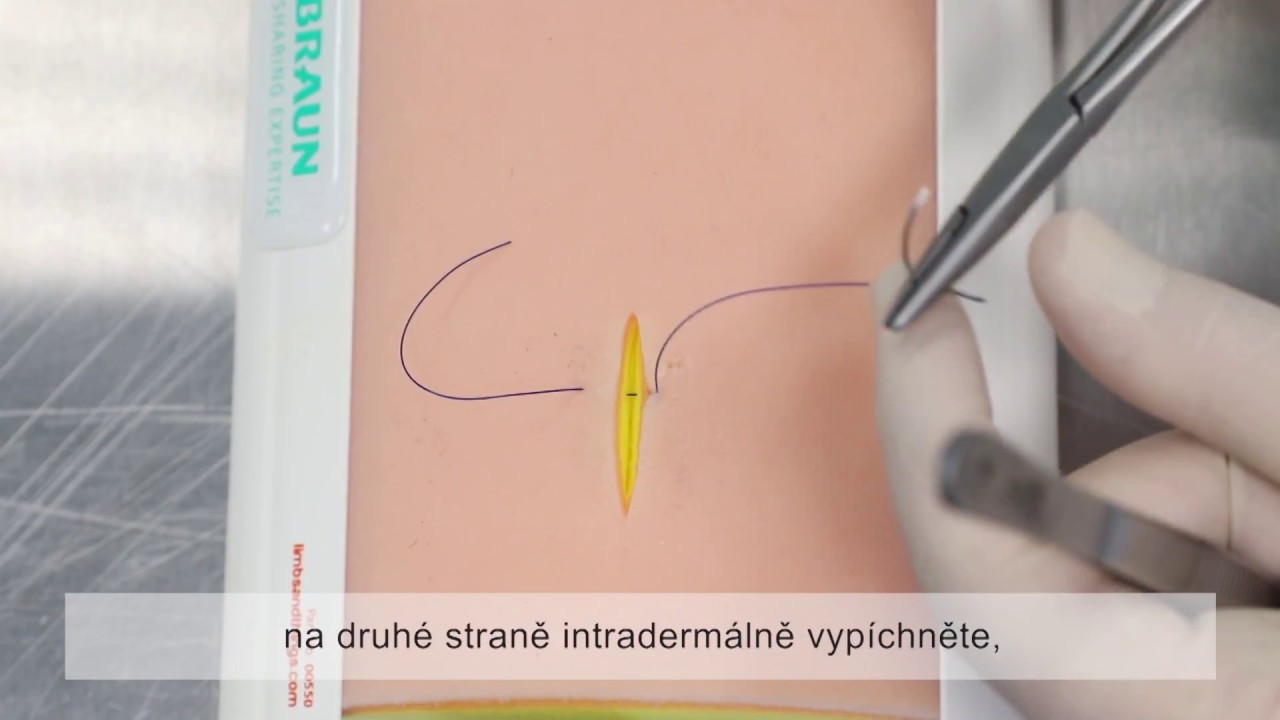 Chirurgické stehy: Autoadaptační steh Algöwerůw (top view)