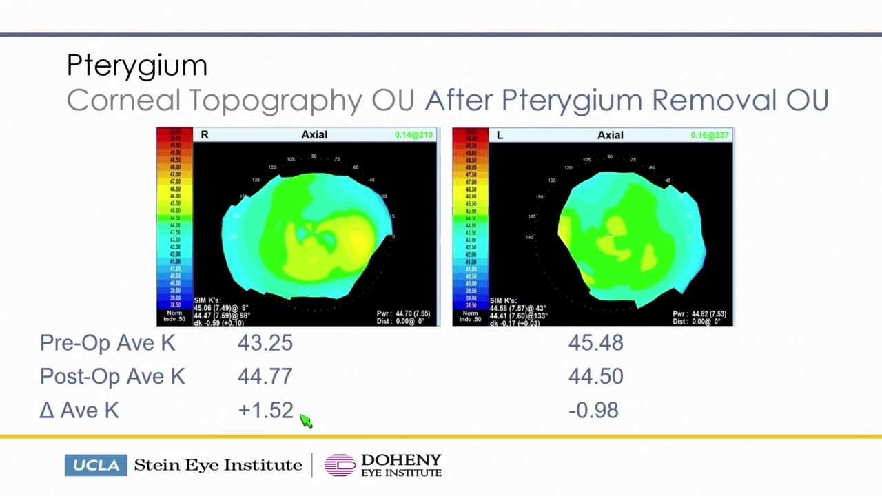Evaluation and Management of Irregular Corneal Astigmatism