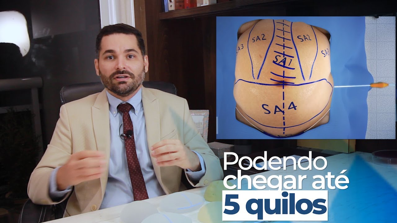 Abdominoplastia EMAGRECE?. Quantos quilos vou EMAGRECER fazendo uma abdominoplastia?