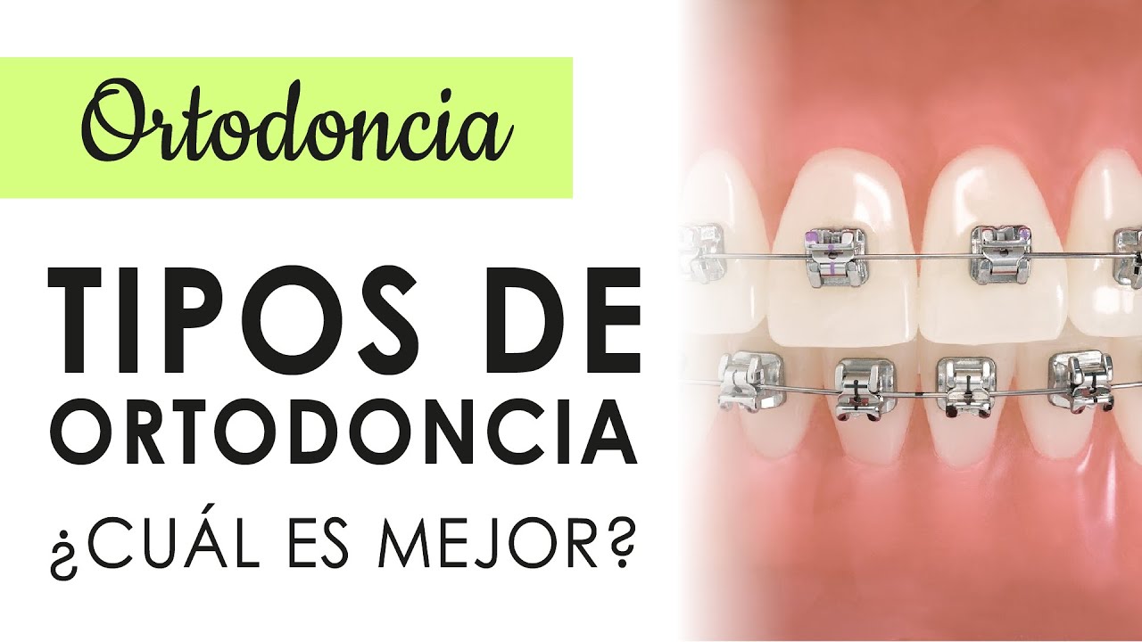 TIPOS DE ORTODONCIA | ¿BRACKETS, ALINEADORES O MINI TUBOS; CUÁL SERÁ MEJOR?