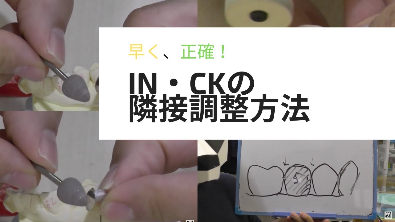 INインレー・CKクラウンの隣接調整方法はこう！・日常歯科治療のコツ・エッセンス