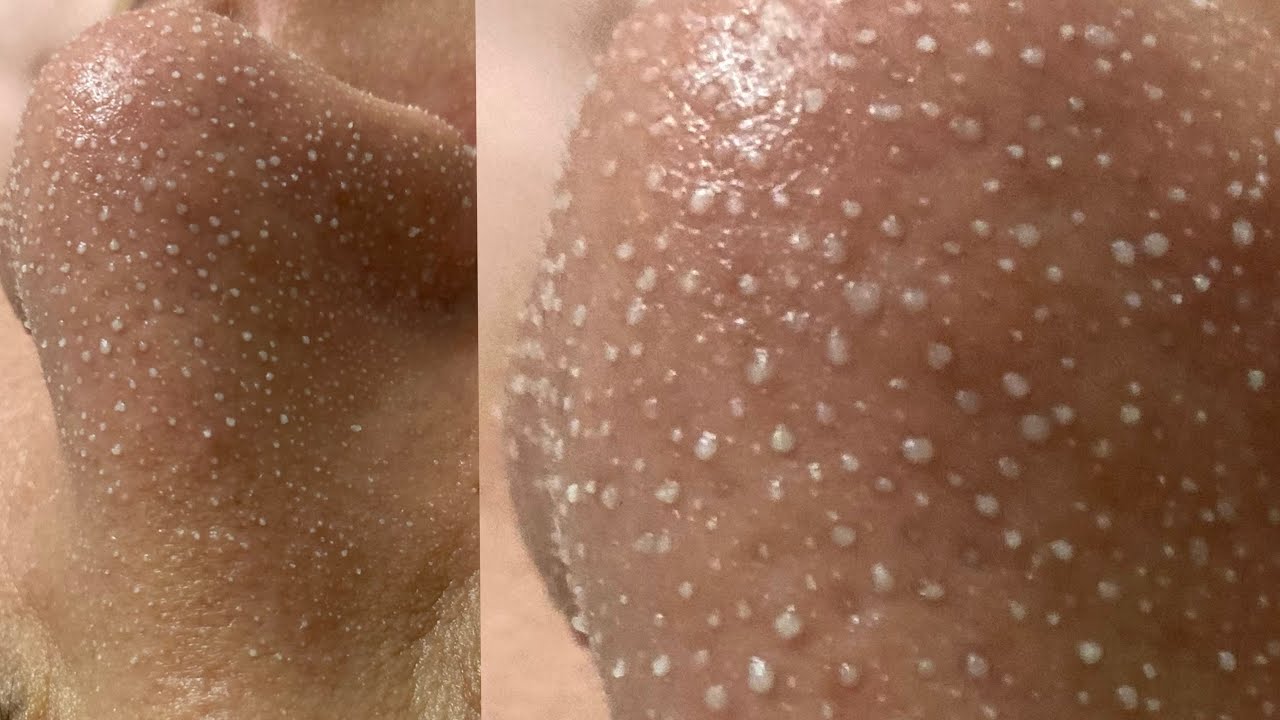 【韓国式3D毛穴洗浄】毛穴パックで角栓を浮かせて黒ずみ吸引 ASMR Blackheads