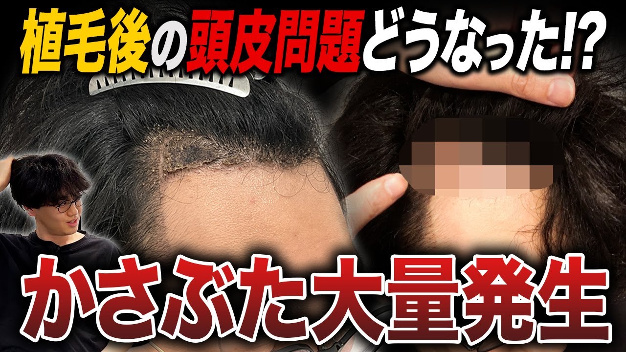 【植毛2ヶ月報告】26歳の術後のかさぶた…これって普通？