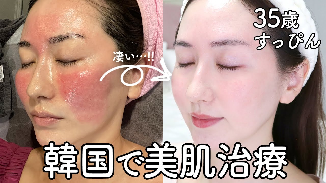 【何歳でも美肌に✨】韓国の美肌治療が凄すぎる…!!!【酒さ】【アトピー】