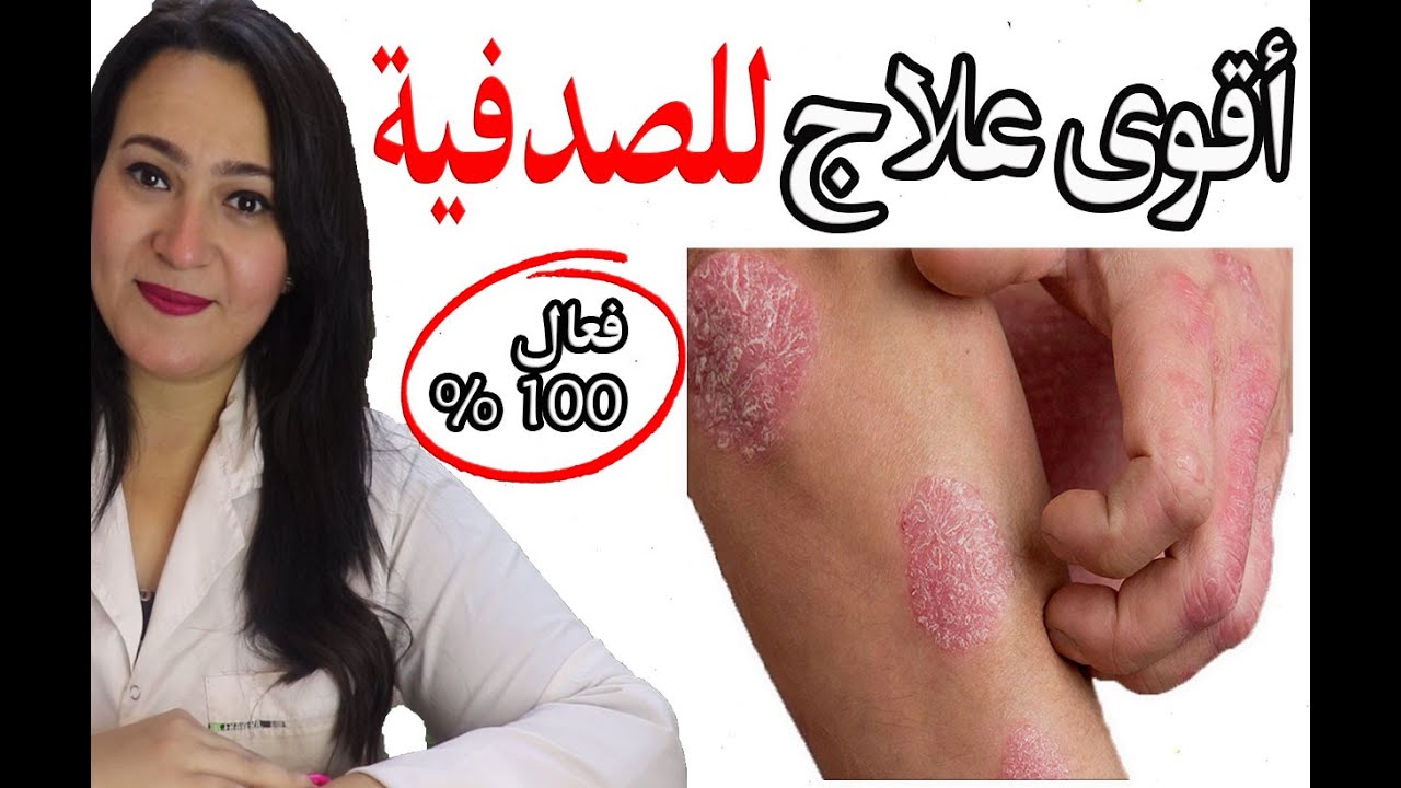 أقوى علاج للصدفية نهائيا في وقت قياسي وفعال 100 % وبدون عودة