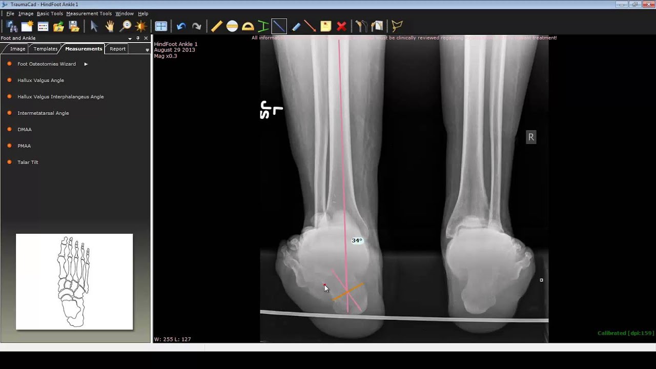 Foot and Ankle Deformity Correction with Dr. Noman Siddiqui - Hindfoot Varus Deformity