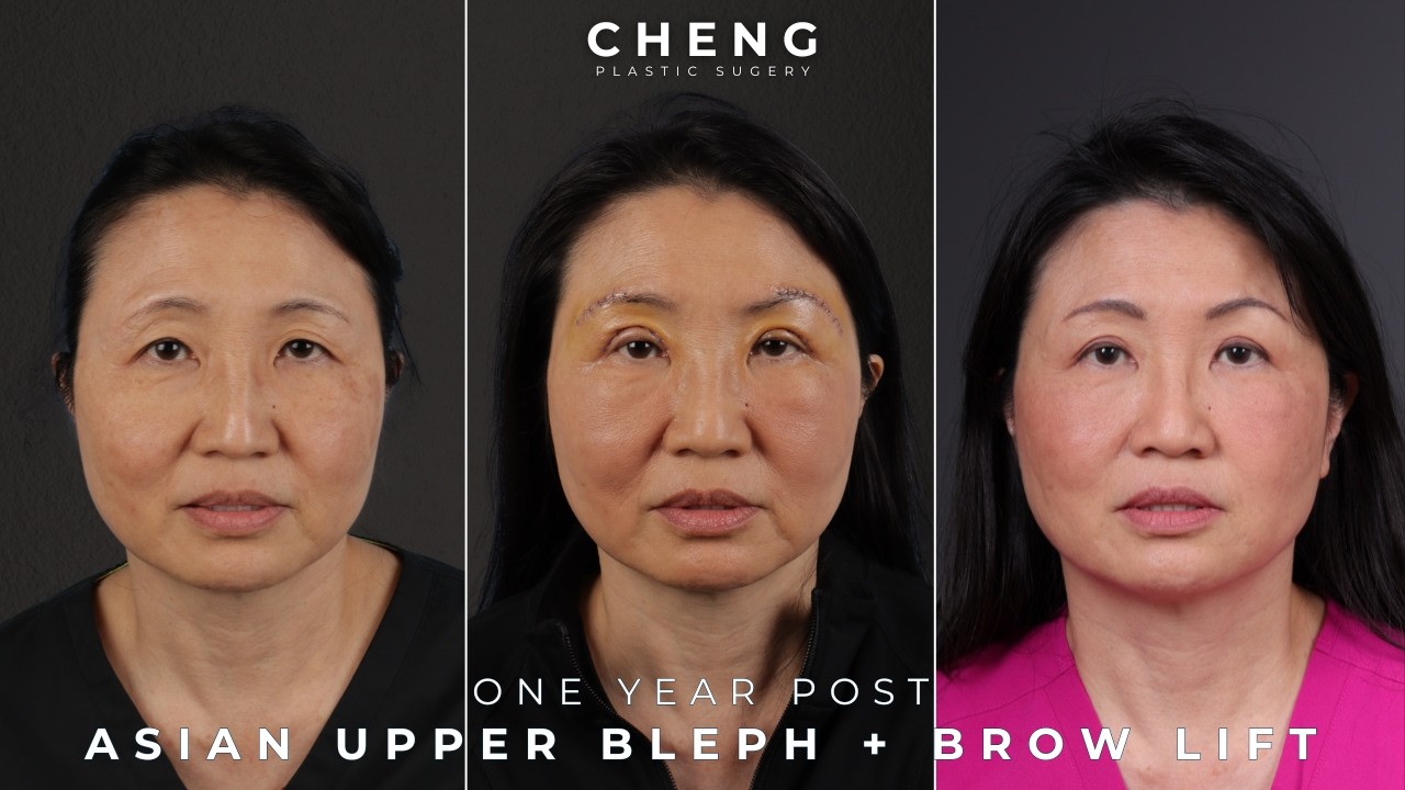 Her Only Regret? Not Doing It Sooner | 1 Year After Asian Eyelid Surgery