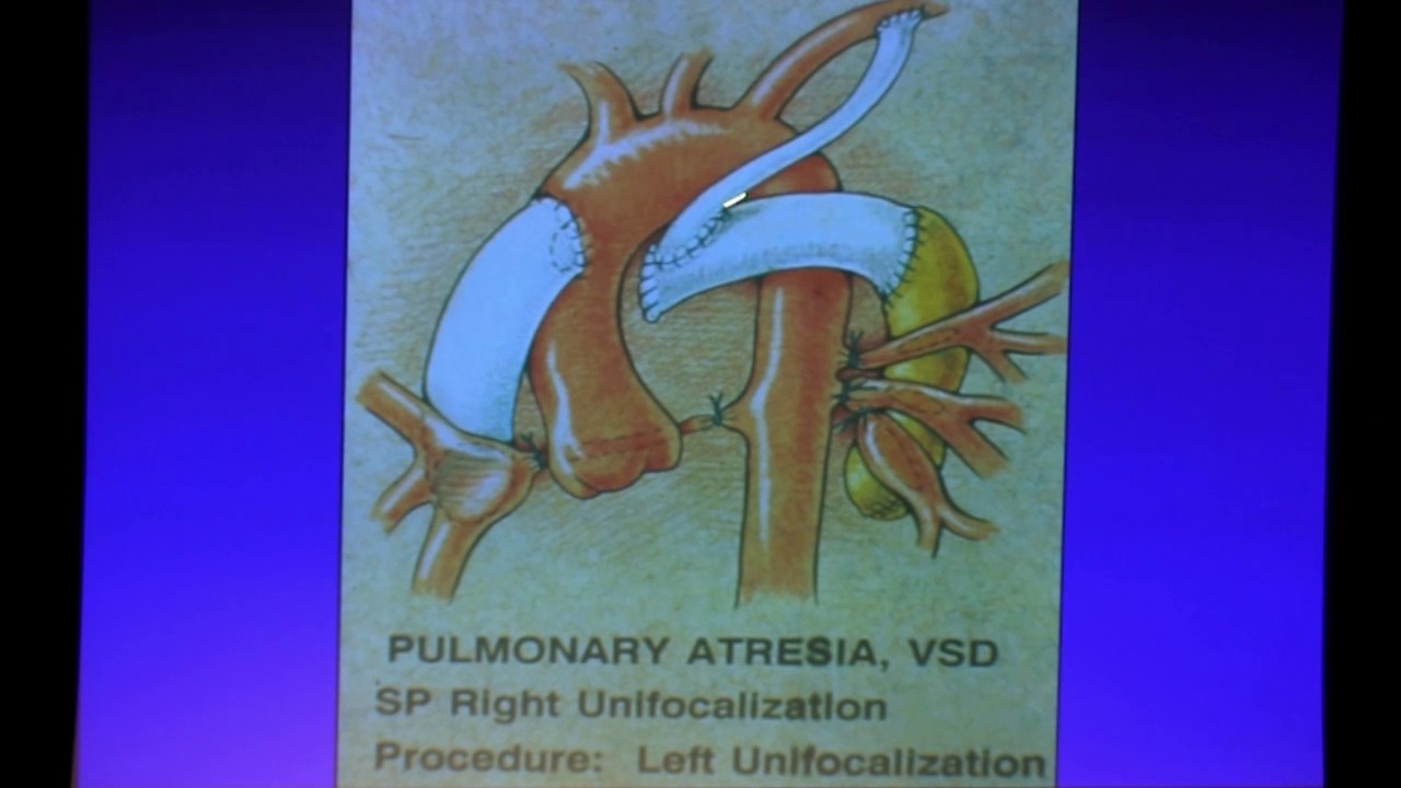Adult Congenital Cardiac Surgery - Dr. Hillel Laks | 2017 UCLA ACHD Symposium