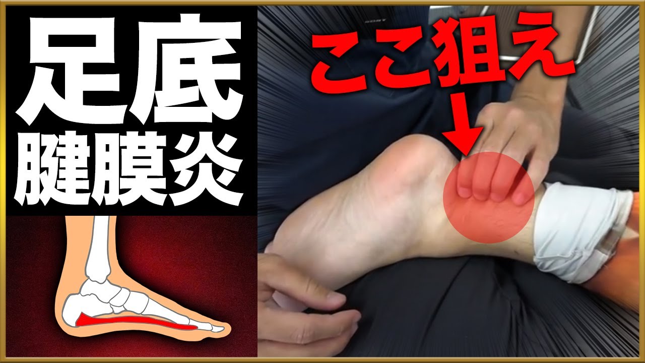 【9割の治療家が勘違い】足底腱膜炎をスパッと解決する黄金テクニックを公開！