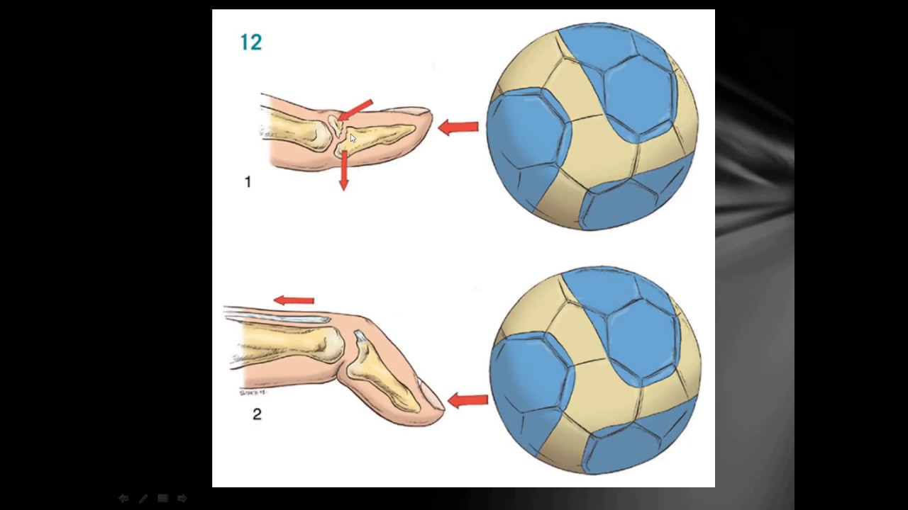 Mallet Finger Orthopaedic lectures