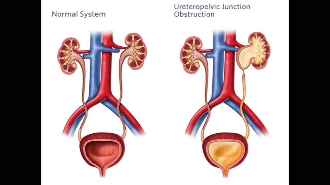 Chicago Metro SUNA Review: Congenital Urinary Obstructions