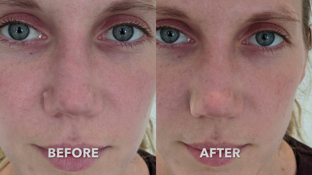 Facial Mole Removal - Latest Techniques for Minimal Scarring. See Before/After Results