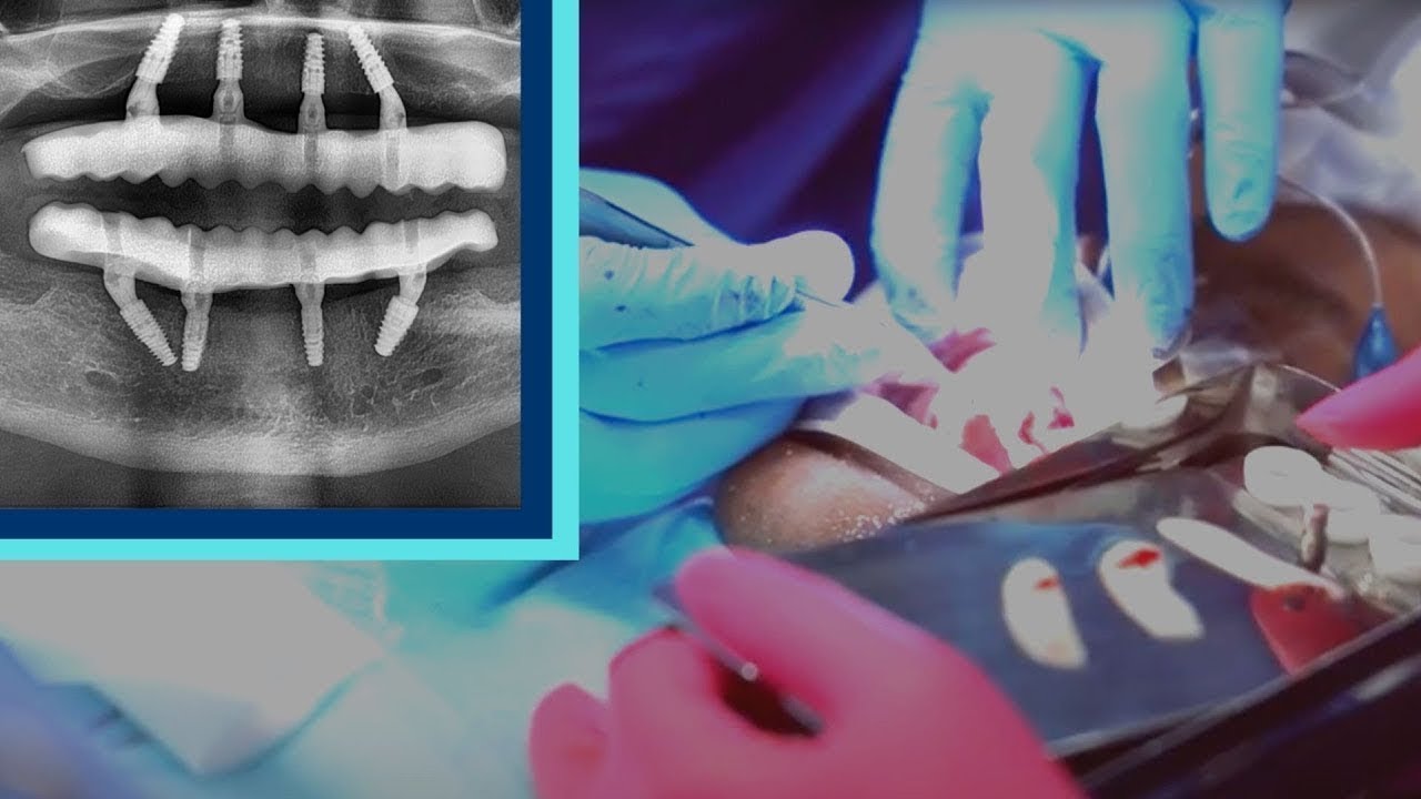 How Long Does It Take To Heal After Dental Implant Surgery?