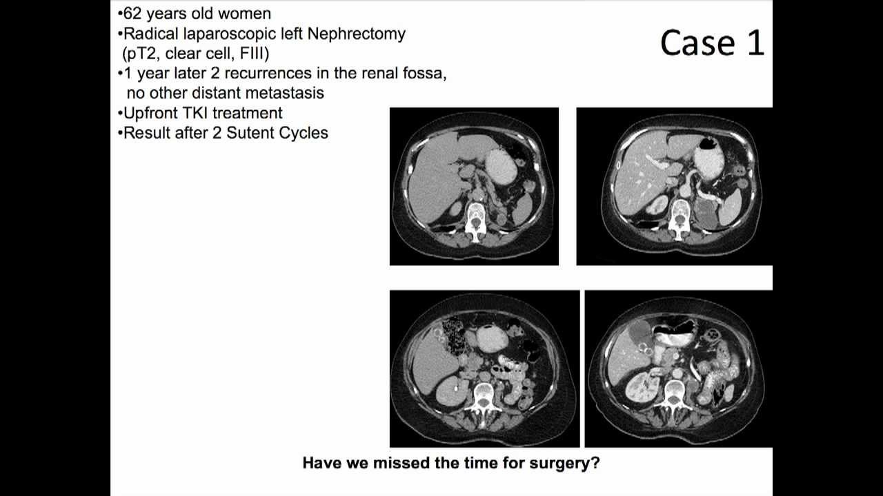 Natural History of Patients with Local Recurrence after Nephrectomy for Localized RCC