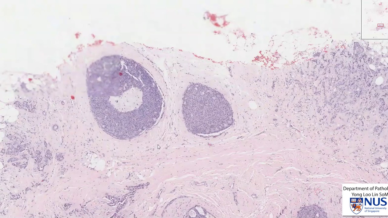 Breast: Invasive ductal  carcinoma vs DCIS